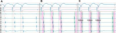 Delineation of intracavitary electrograms for the automatic quantification of decrement-evoked potentials in the coronary sinus with deep-learning techniques